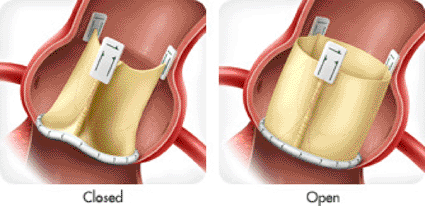 Image: The ATS 3f replacement aortic bioprosthesis (Photo courtesy ATS Medical).